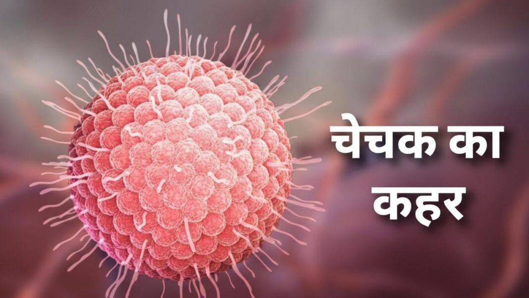 Triveniganj Chicken Pox Outbreak Alert! दो दर्जन बच्चे बीमार, गांव में दहशत