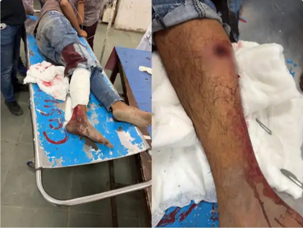 सूरत में हत्या आरोपित का पुलिस पर हमला, जवाबी फायरिंग में पैर में लगी गोली सूरत में हत्या आरोपित का पुलिस पर हमला, जवाबी फायरिंग में पैर में लगी गोली